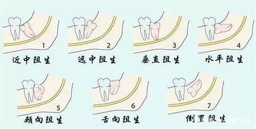 發(fā)炎的智齒什么時候拔才好？有些情況不能拔