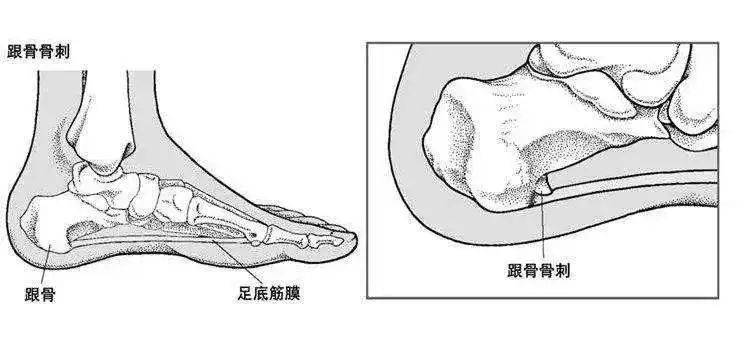 骨刺不是??？切勿過(guò)度治療！