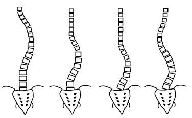 脊柱側(cè)彎如何康復(fù)？河南省中醫(yī)院西區(qū)醫(yī)院專家這樣說